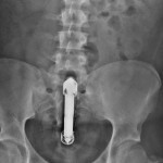 vibrator_a_fenekeben_RTG_felvetel